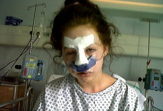 CHLOE had to undergo two operations 