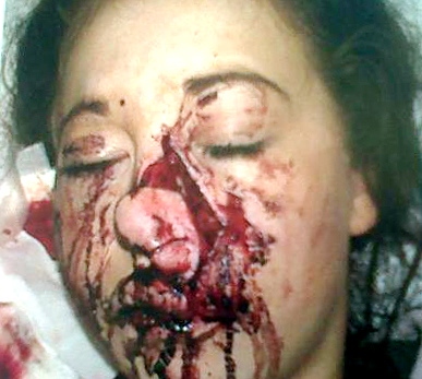 SHAW teenager Chloe Walker after she was attacked by a dog while visiting a friend’s relative 