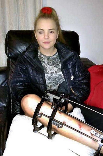 Chloe after her accident - at one point she though she might lose her leg, but has fought back to walk unaided again