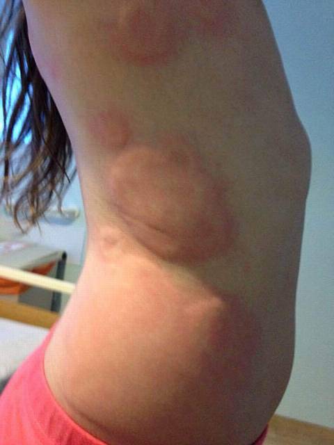 Esther Lunt (10) wsa diagnosed with Lyme disease. Her parents pastors Mary Lunt and David Lunt, from Dunamis Church, Failsworth, are raising £100,000 for her treatment in the USA. Pic shows the rashes on her body as a result of being bitten by a tick. 
