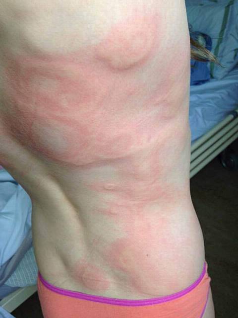 Esther Lunt (10) wsa diagnosed with Lyme disease. Her parents pastors Mary Lunt and David Lunt, from Dunamis Church, Failsworth, are raising £100,000 for her treatment in the USA. Pic shows the rashes on her body as a result of being bitten by a tick. 
