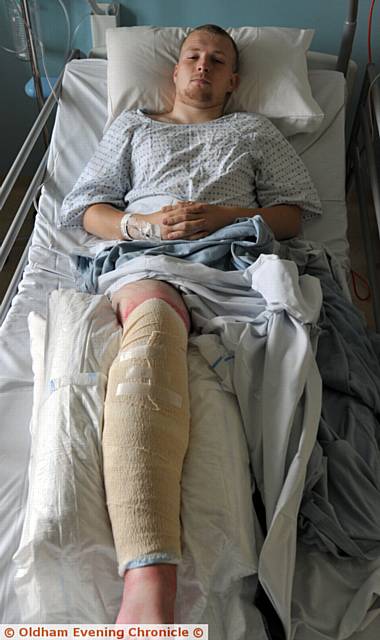 Footballer Alex Cook fractured his leg playing for AFC Oldham.