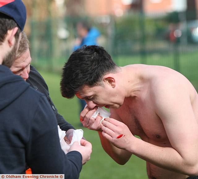 Daisyfield Rangers V Royton Park, match played at Oasis Academy, Oldham. Chris Morris, playing for Daisyfield, with a bloody nose after a tackle.