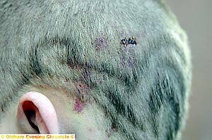 THE cuts to Daniel’s head allegedly caused when police hit him with a pair of handcuffs 