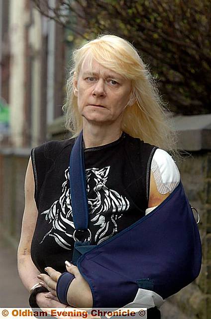 ROAD rage . . . Susan Burridge with her injured left arm ROAD rage . . . Susan Burridge with her injured left arm