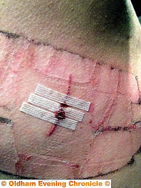 THE wound in Craig’s side  

