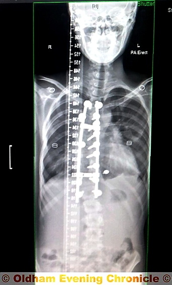 SURGEONS inserted metal rods in Natalie’s spine in a dangerous operation 