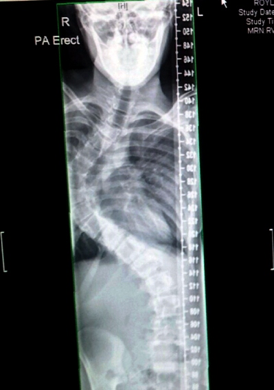 Natalie’s spine before the operation  

