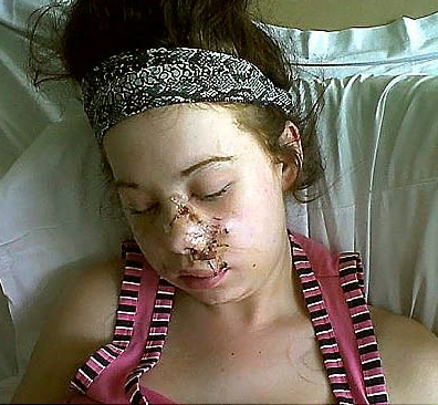 Chloe was badly injured in a dog attack in 2011  

