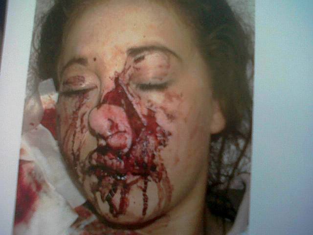 Chloe Walker attacked by Dog 
