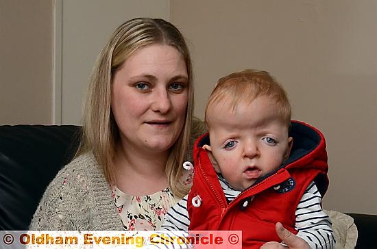 Adele Lichfield with her son Oliver Young (15 months) who suffers from Apert syndrome, a rare problem with his skull.