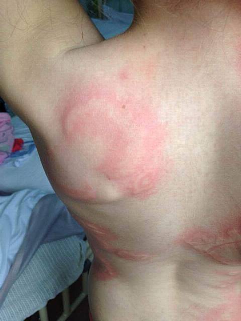 Esther Lunt (10) wsa diagnosed with Lyme disease. Her parents pastors Mary Lunt and David Lunt, from Dunamis Church, Failsworth, are raising £100,000 for her treatment in the USA. Pic shows the rashes on her body as a result of being bitten by a tick. 
