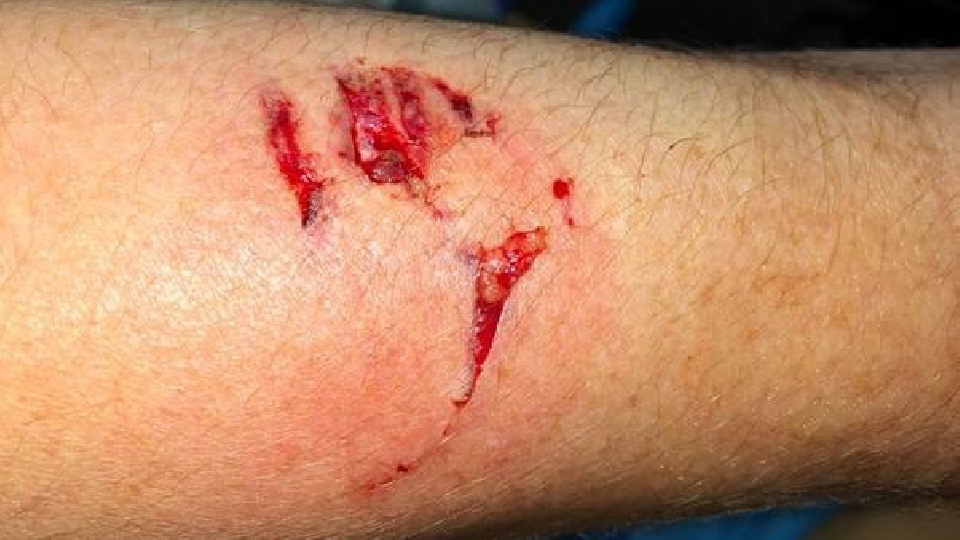 This is the bite injury the officer was left with. This is the bite injury the officer was left with.