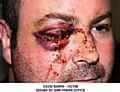 THE terrible injuries Dave Barry suffered which cost him his right eye 