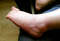 The burn on toddler Lily Mae’s foot 

