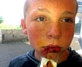 Marcus Barnes: mauled by friend's dog. 
