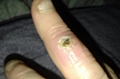 Marilyn Richards' finger after she was bittne by a spider