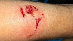 This is the bite injury the officer was left with.